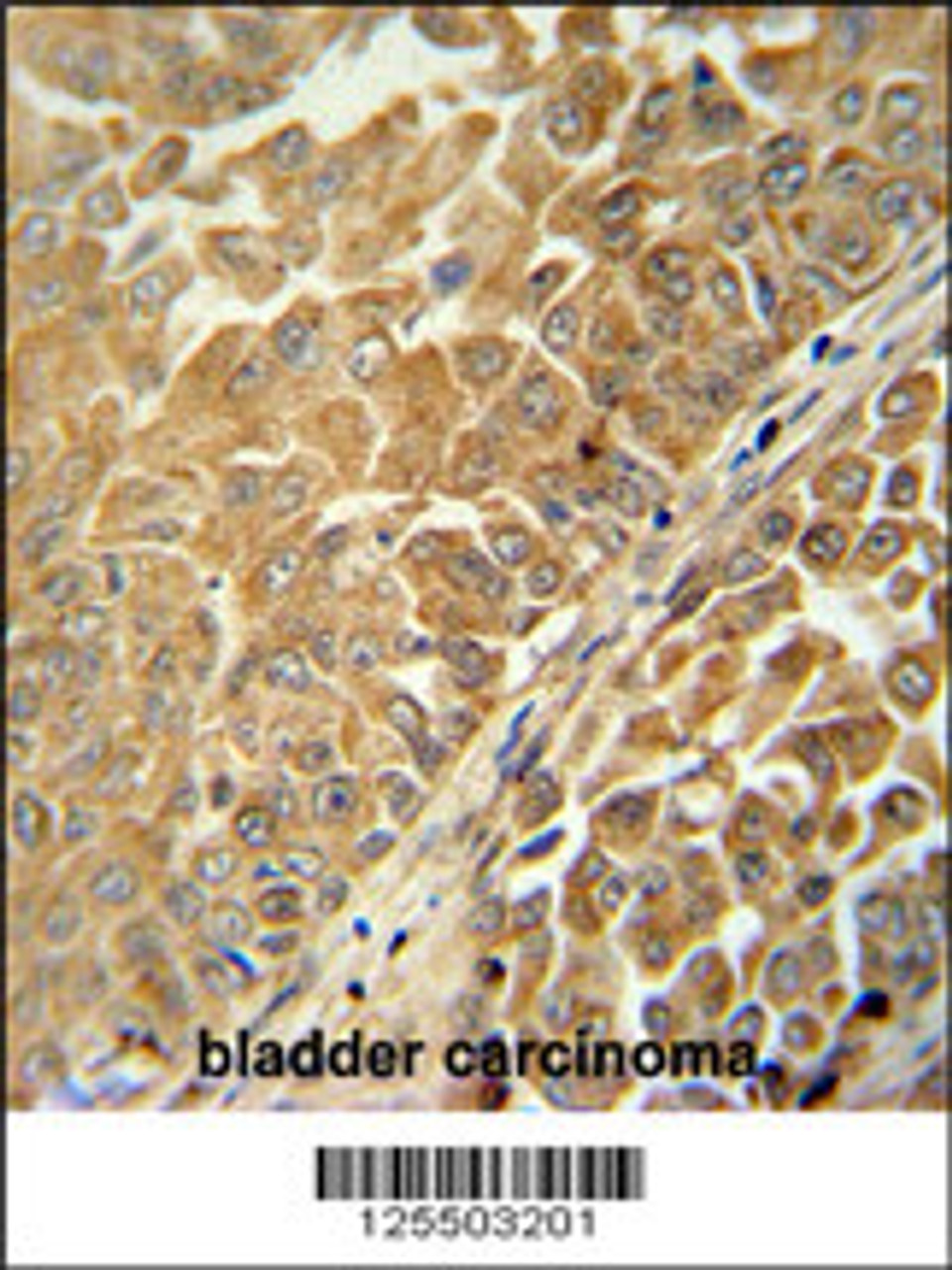 CR025 antibody immunohistochemistry analysis in formalin fixed and paraffin embedded human bladder carcinoma followed by peroxidase conjugation of the secondary antibody and DAB staining.