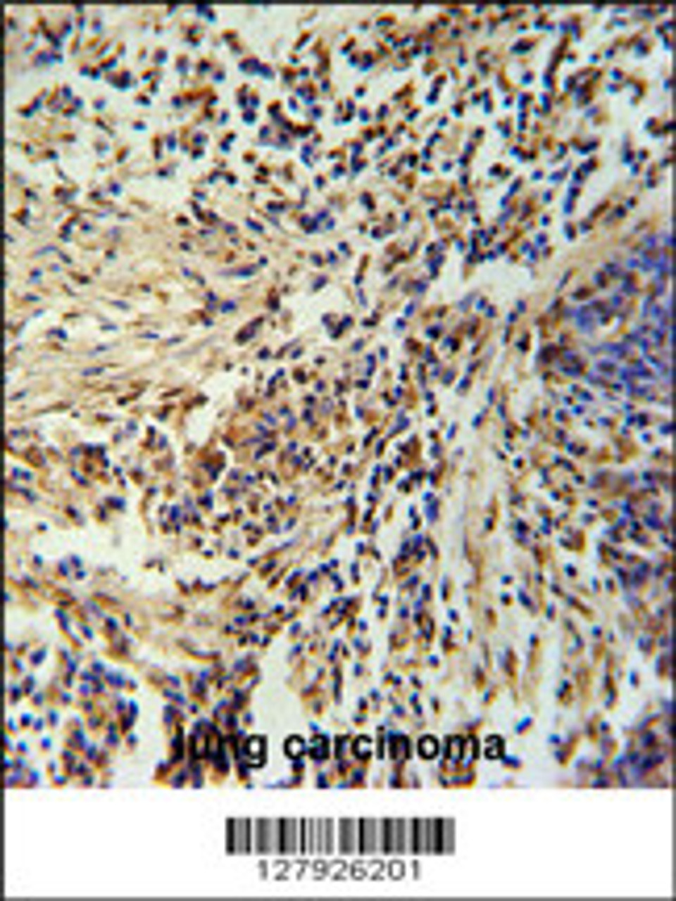 ZNF720 Antibody immunohistochemistry analysis in formalin fixed and paraffin embedded human lung carcinoma followed by peroxidase conjugation of the secondary antibody and DAB staining.
