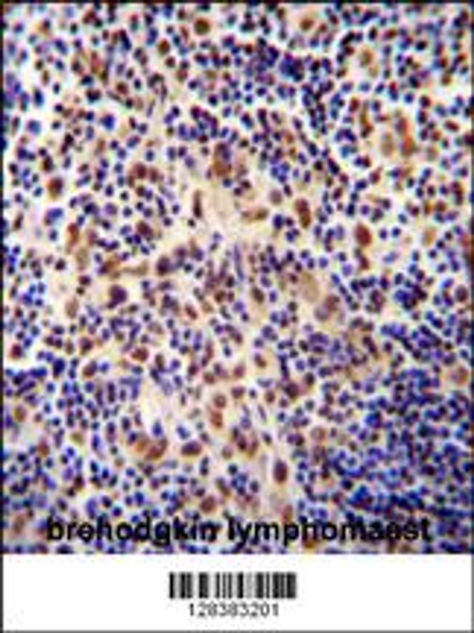 TIGD3 antibody immunohistochemistry analysis in formalin fixed and paraffin embedded human hodgkin lymphoma followed by peroxidase conjugation of the secondary antibody and DAB staining.