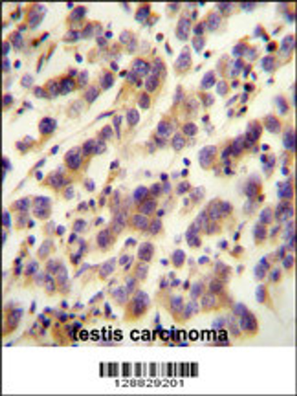 OR1J4 antibody immunohistochemistry analysis in formalin fixed and paraffin embedded human testis carcinoma followed by peroxidase conjugation of the secondary antibody and DAB staining.