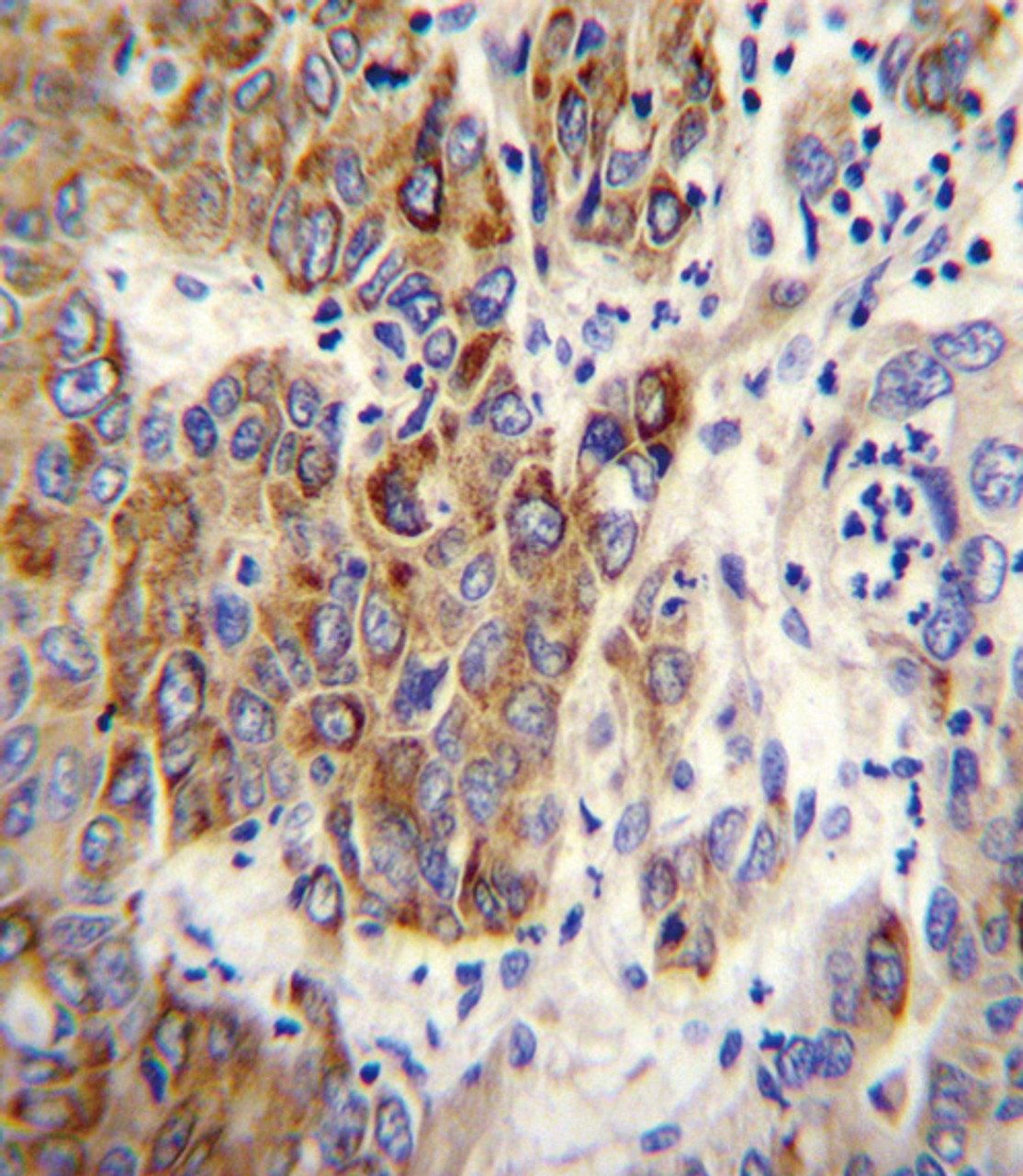 CYP2B6 Antibody immunohistochemistry analysis in formalin fixed and paraffin embedded human hepatocarcinoma followed by peroxidase conjugation of the secondary antibody and DAB staining.