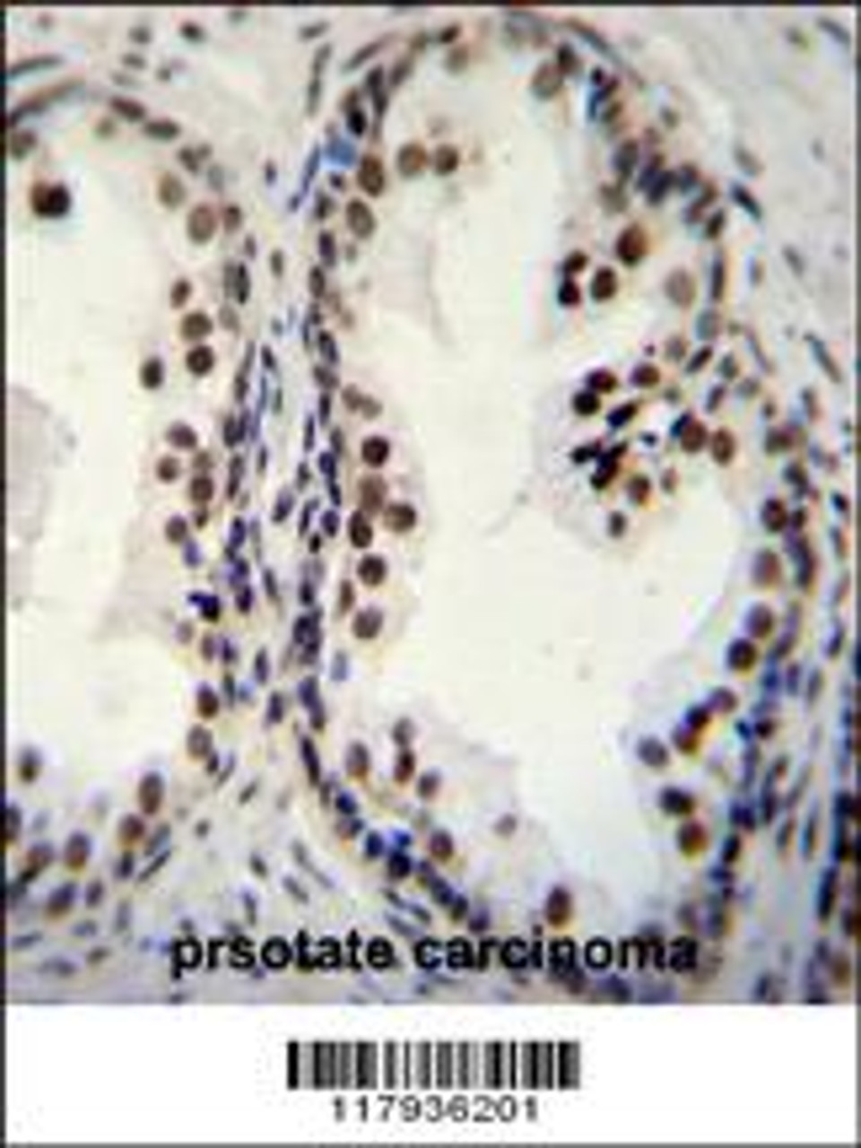 DDX27 Antibody immunohistochemistry analysis in formalin fixed and paraffin embedded human prsotate carcinoma followed by peroxidase conjugation of the secondary antibody and DAB staining.