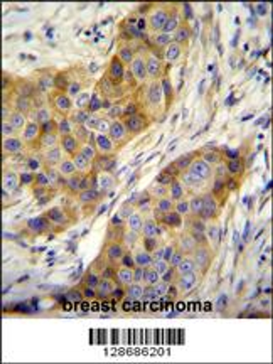 ANR39 Antibody immunohistochemistry analysis in formalin fixed and paraffin embedded human breast carcinoma followed by peroxidase conjugation of the secondary antibody and DAB staining.