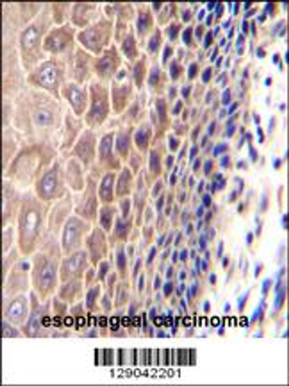 CCDC97 Antibody immunohistochemistry analysis in formalin fixed and paraffin embedded human esophageal carcinoma followed by peroxidase conjugation of the secondary antibody and DAB staining.