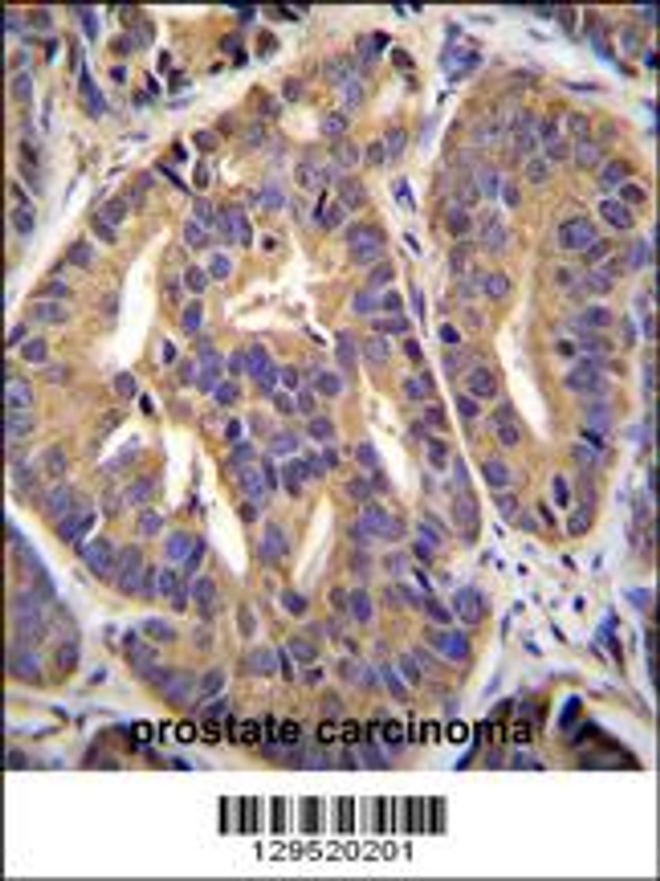 GTF2H2C Antibody immunohistochemistry analysis in formalin fixed and paraffin embedded human prostate carcinoma followed by peroxidase conjugation of the secondary antibody and DAB staining.