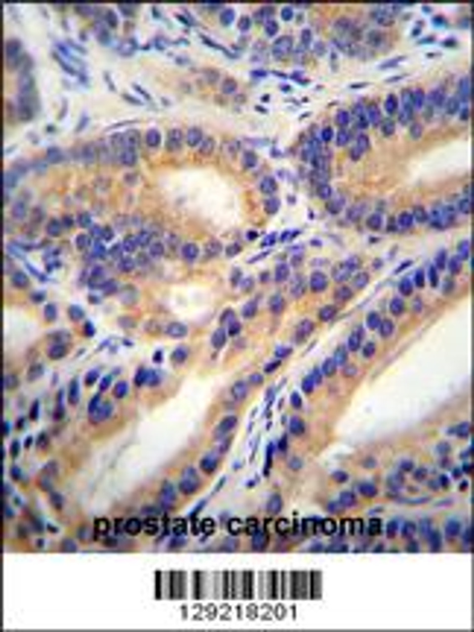HSD11B1L Antibody immunohistochemistry analysis in formalin fixed and paraffin embedded human prostate carcinoma followed by peroxidase conjugation of the secondary antibody and DAB staining.