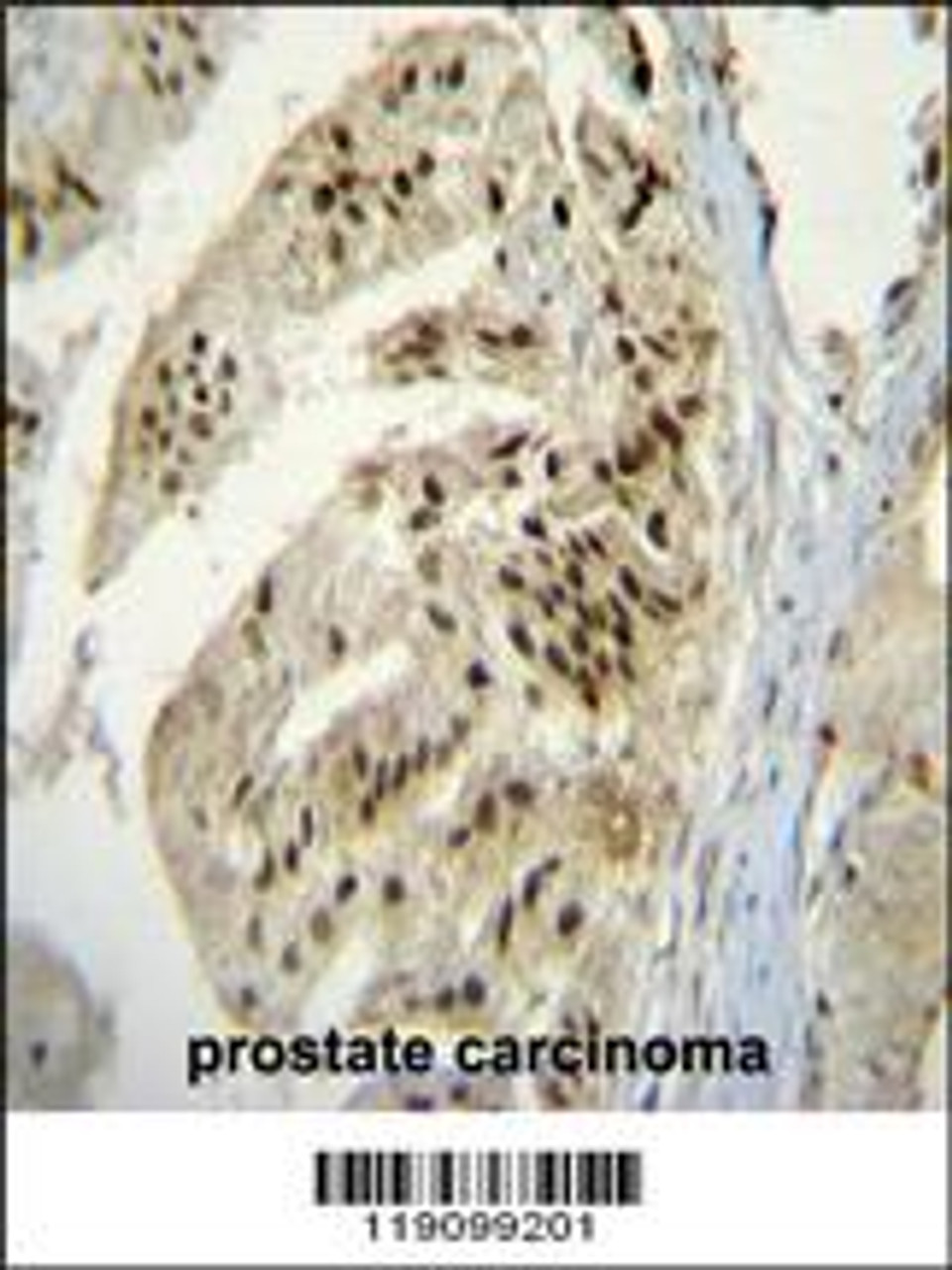 PAP Antibody immunohistochemistry analysis in formalin fixed and paraffin embedded human prostate carcinoma followed by peroxidase conjugation of the secondary antibody and DAB staining.