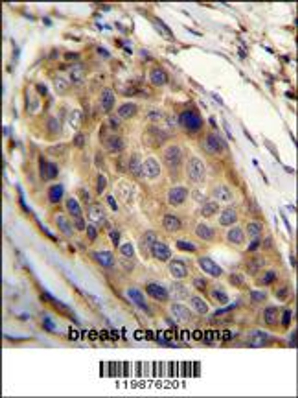 SSH3 Antibody immunohistochemistry analysis in formalin fixed and paraffin embedded human breast carcinoma followed by peroxidase conjugation of the secondary antibody and DAB staining.