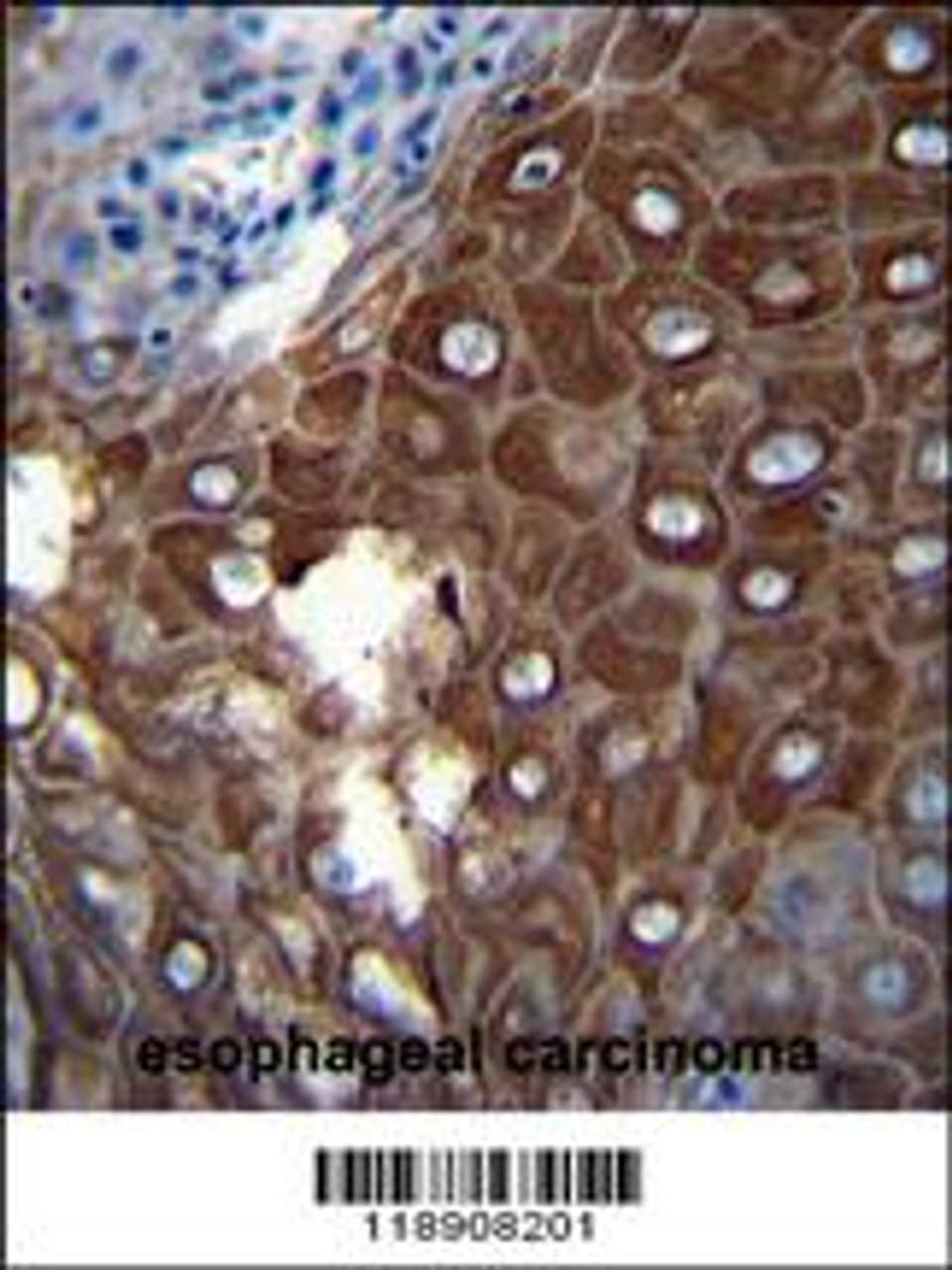 MMP1 Antibody immunohistochemistry analysis in formalin fixed and paraffin embedded human esophageal carcinoma followed by peroxidase conjugation of the secondary antibody and DAB staining.