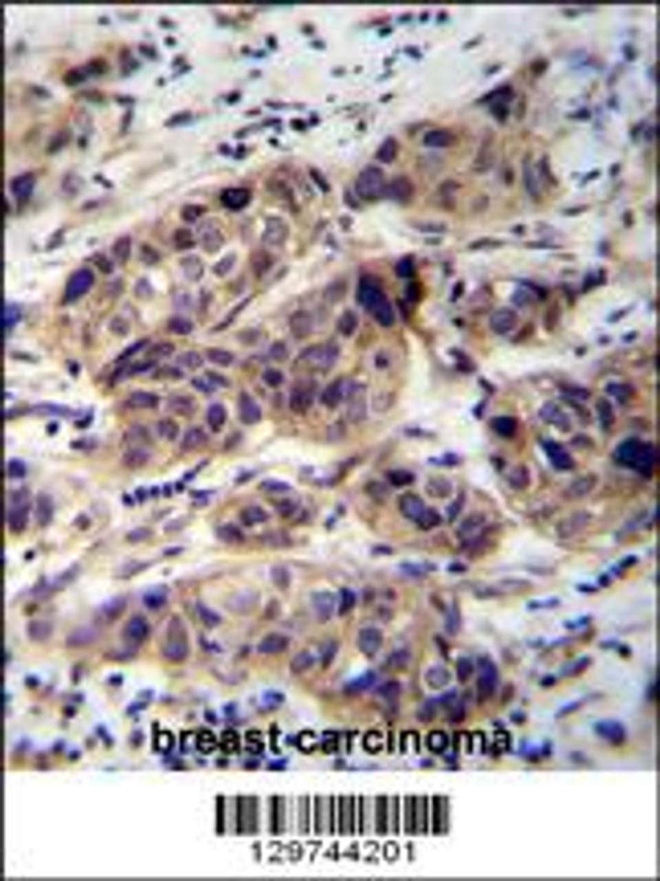 WDR42C Antibody immunohistochemistry analysis in formalin fixed and paraffin embedded human breast carcinoma followed by peroxidase conjugation of the secondary antibody and DAB staining.