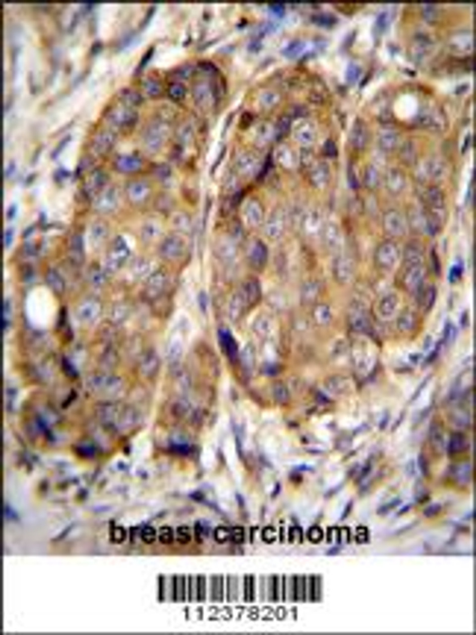 METTL2 Antibody immunohistochemistry analysis in formalin fixed and paraffin embedded human breast carcinoma followed by peroxidase conjugation of the secondary antibody and DAB staining.