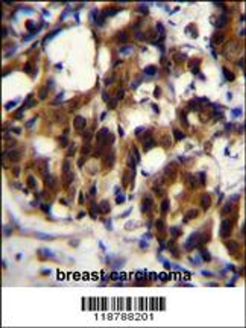 TRADD Antibody immunohistochemistry analysis in formalin fixed and paraffin embedded human breast carcinoma followed by peroxidase conjugation of the secondary antibody and DAB staining.