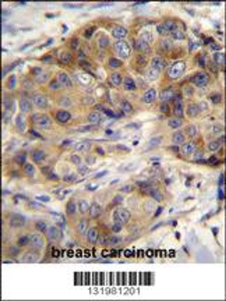 GSR Antibody immunohistochemistry analysis in formalin fixed and paraffin embedded human breast carcinoma followed by peroxidase conjugation of the secondary antibody and DAB staining.