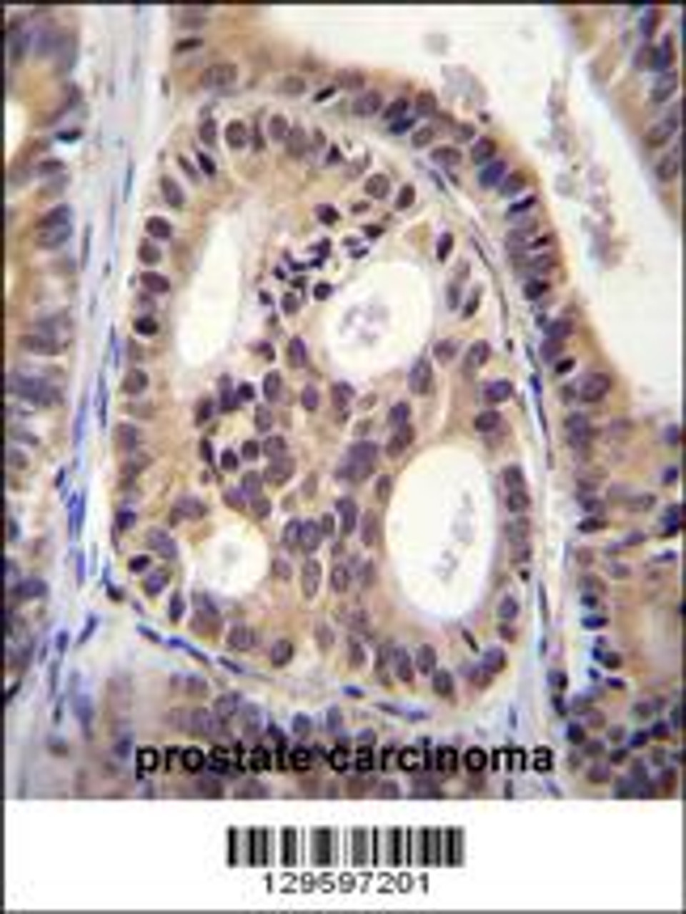 CYTSA Antibody immunohistochemistry analysis in formalin fixed and paraffin embedded human prostate carcinoma followed by peroxidase conjugation of the secondary antibody and DAB staining.