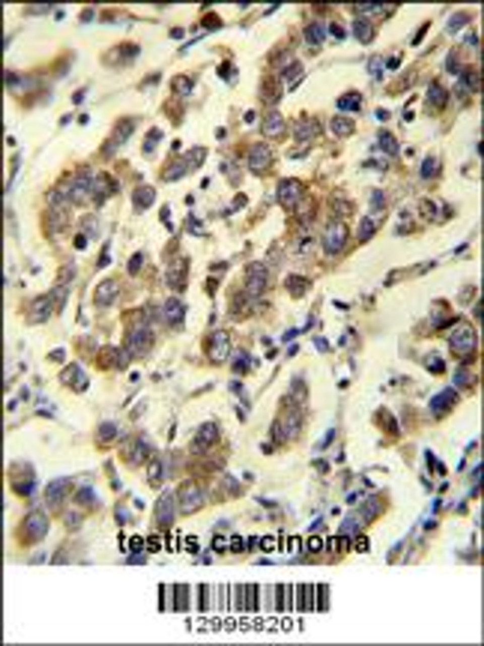 MBD3L3 Antibody immunohistochemistry analysis in formalin fixed and paraffin embedded human testis carcinoma followed by peroxidase conjugation of the secondary antibody and DAB staining.