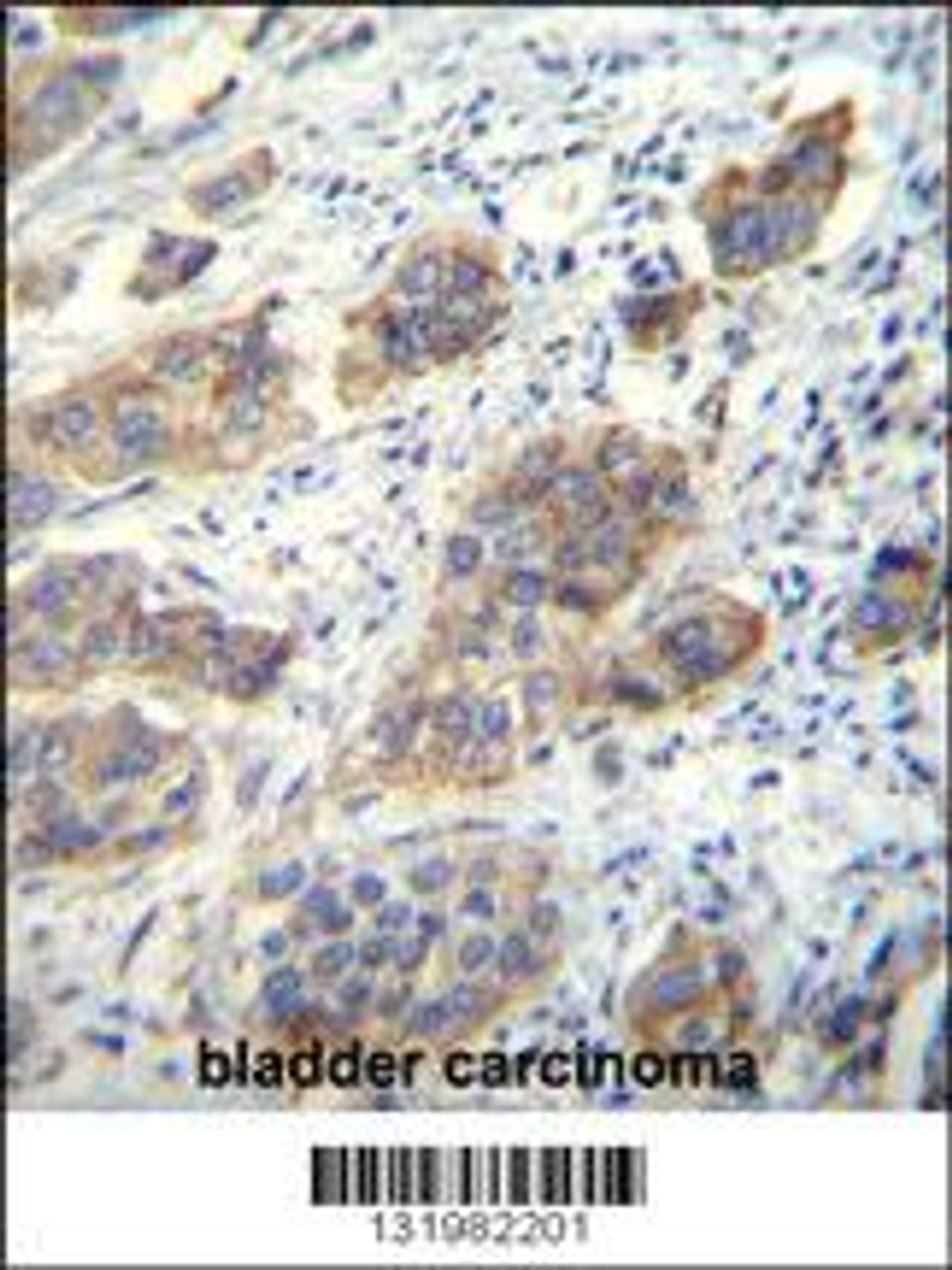 CDH24 Antibody immunohistochemistry analysis in formalin fixed and paraffin embedded human bladder carcinoma followed by peroxidase conjugation of the secondary antibody and DAB staining.