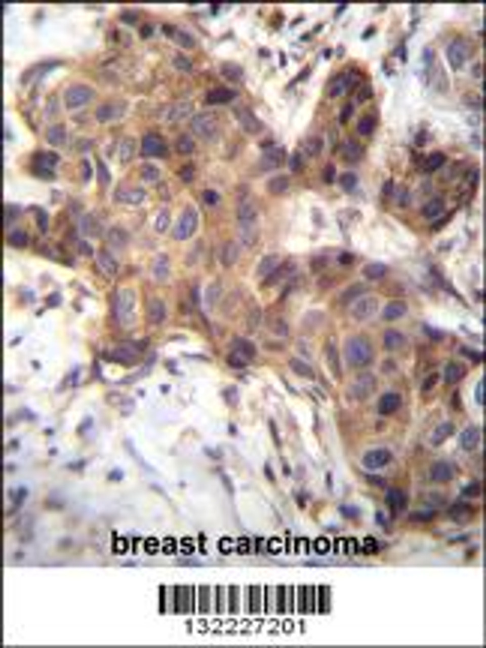 GDF9 Antibody immunohistochemistry analysis in formalin fixed and paraffin embedded human breast carcinoma followed by peroxidase conjugation of the secondary antibody and DAB staining.