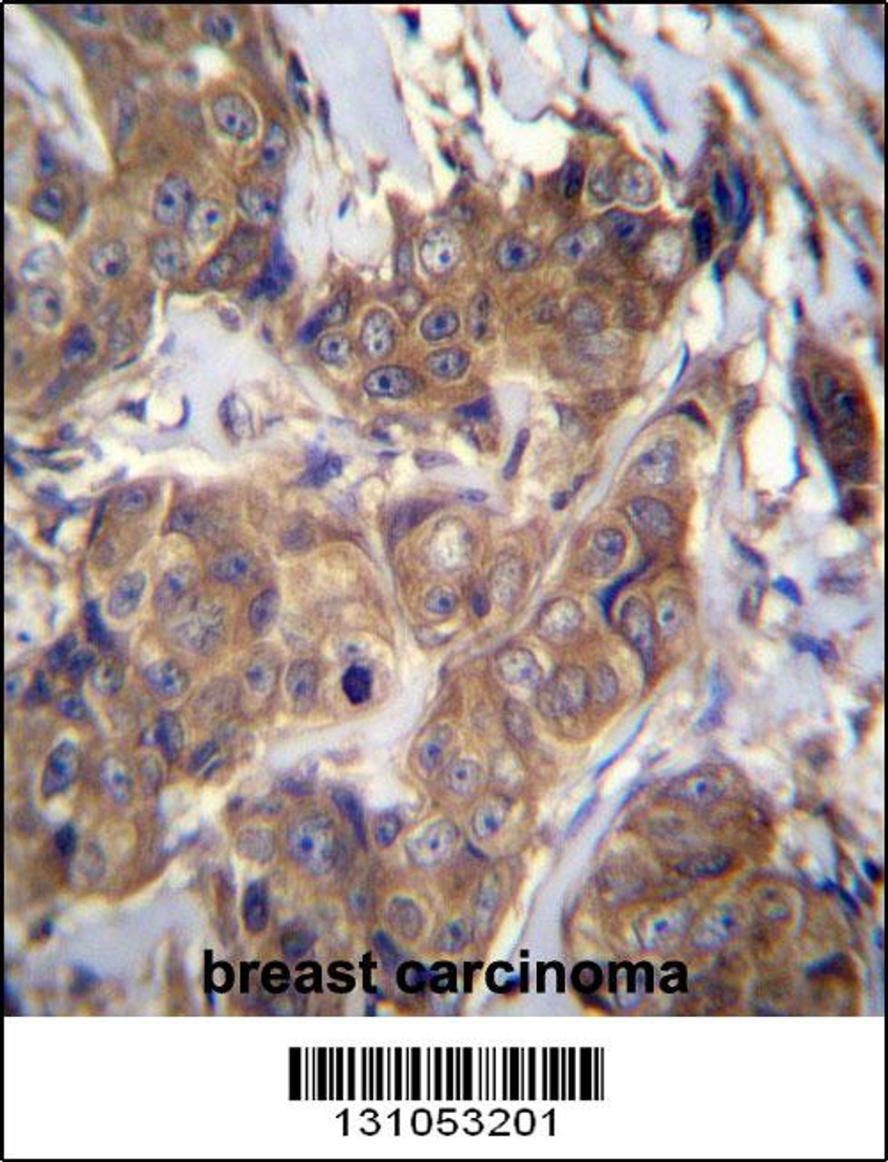 ATP6V1B1 Antibody immunohistochemistry analysis in formalin fixed and paraffin embedded human breast carcinoma followed by peroxidase conjugation of the secondary antibody and DAB staining.