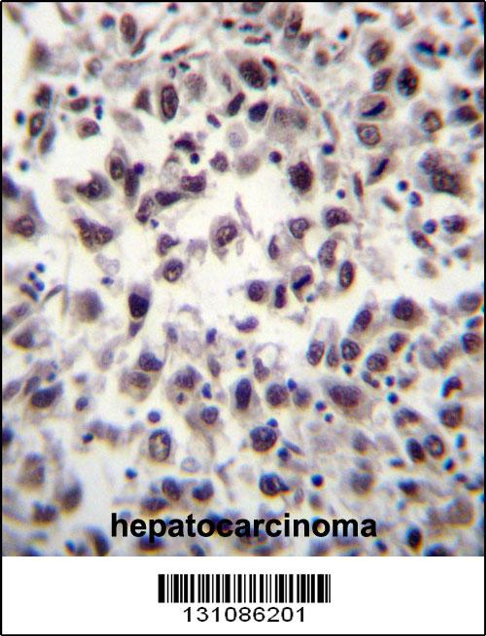 SFRS7 Antibody immunohistochemistry analysis in formalin fixed and paraffin embedded human hepatocarcinoma tissue followed by peroxidase conjugation of the secondary antibody and DAB staining.