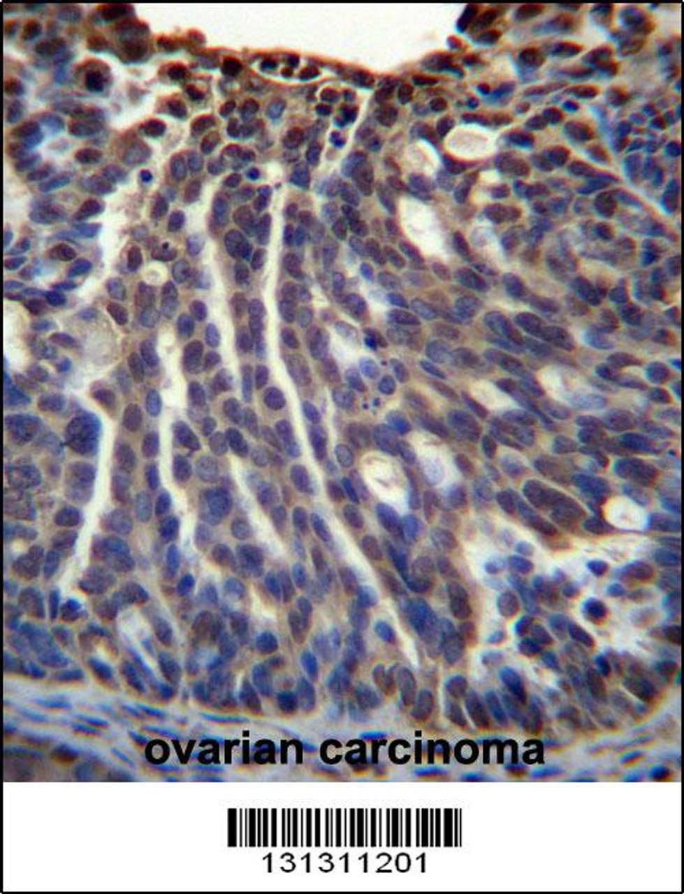 HOXB3 Antibody immunohistochemistry analysis in formalin fixed and paraffin embedded human ovarian carcinoma followed by peroxidase conjugation of the secondary antibody and DAB staining.