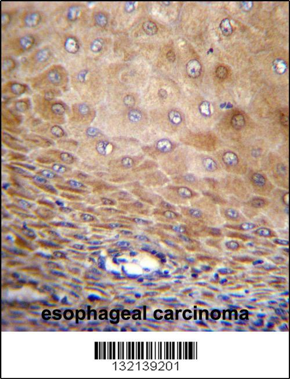 TMEM43 Antibody immunohistochemistry analysis in formalin fixed and paraffin embedded human esophageal carcinoma followed by peroxidase conjugation of the secondary antibody and DAB staining.