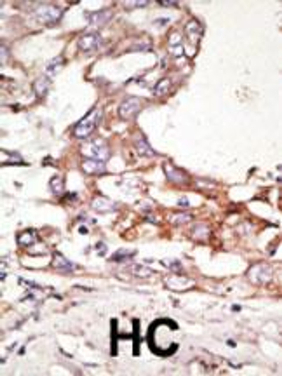 Formalin-fixed and paraffin-embedded human cancer tissue reacted with the primary antibody, which was peroxidase-conjugated to the secondary antibody, followed by AEC staining. BC = breast carcinoma; HC = hepatocarcinoma.