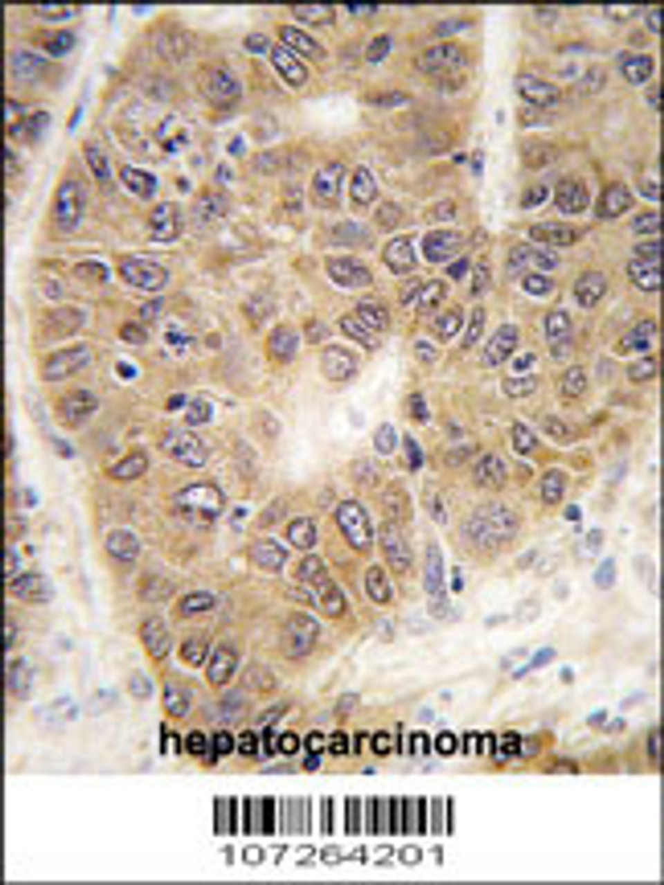 Formalin-fixed and paraffin-embedded human hepatocarcinoma tissue reacted with SUMO4 antibody (V55 Mutant) , which was peroxidase-conjugated to the secondary antibody, followed by DAB staining.