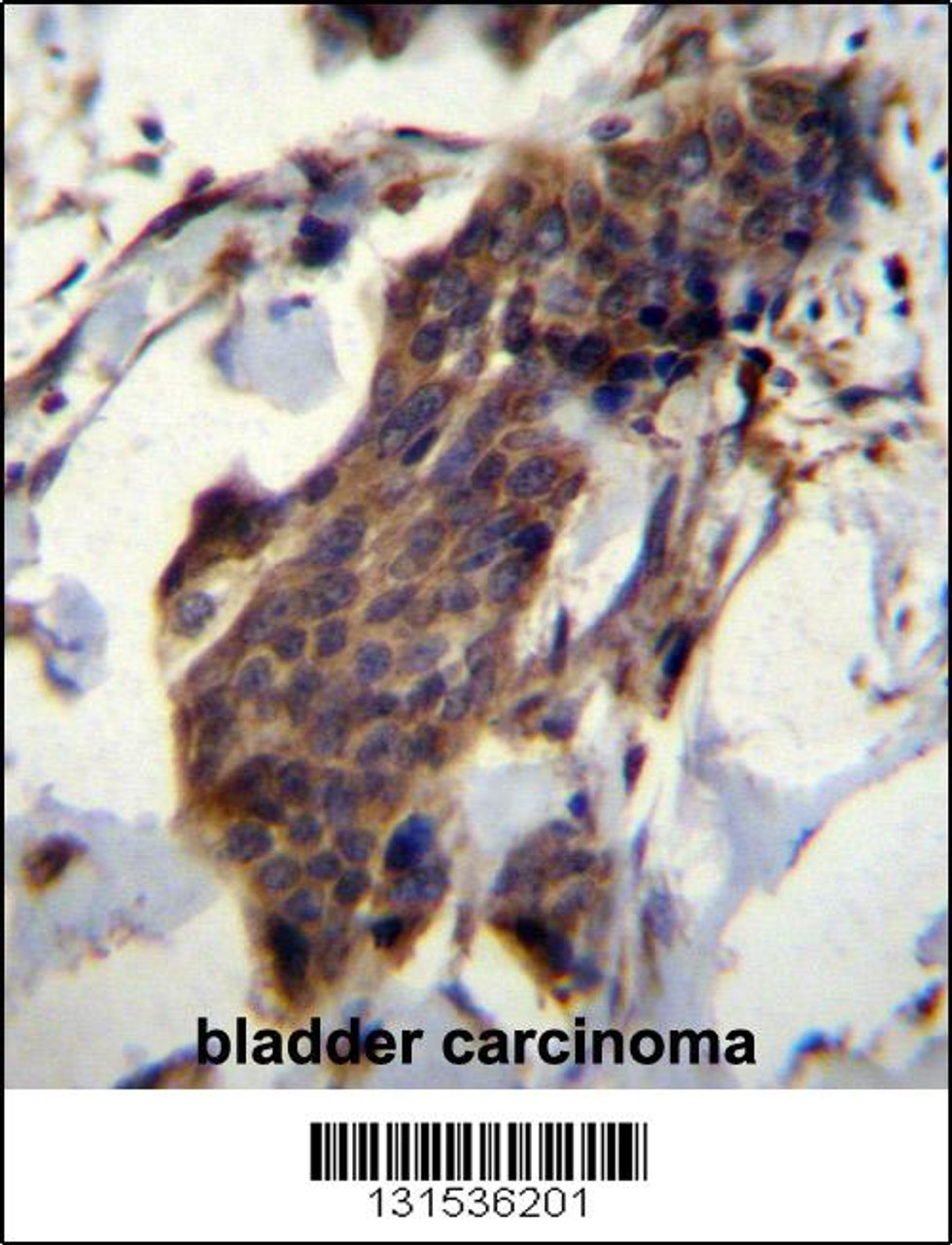 CCDC13 Antibody immunohistochemistry analysis in formalin fixed and paraffin embedded human bladder carcinoma followed by peroxidase conjugation of the secondary antibody and DAB staining.