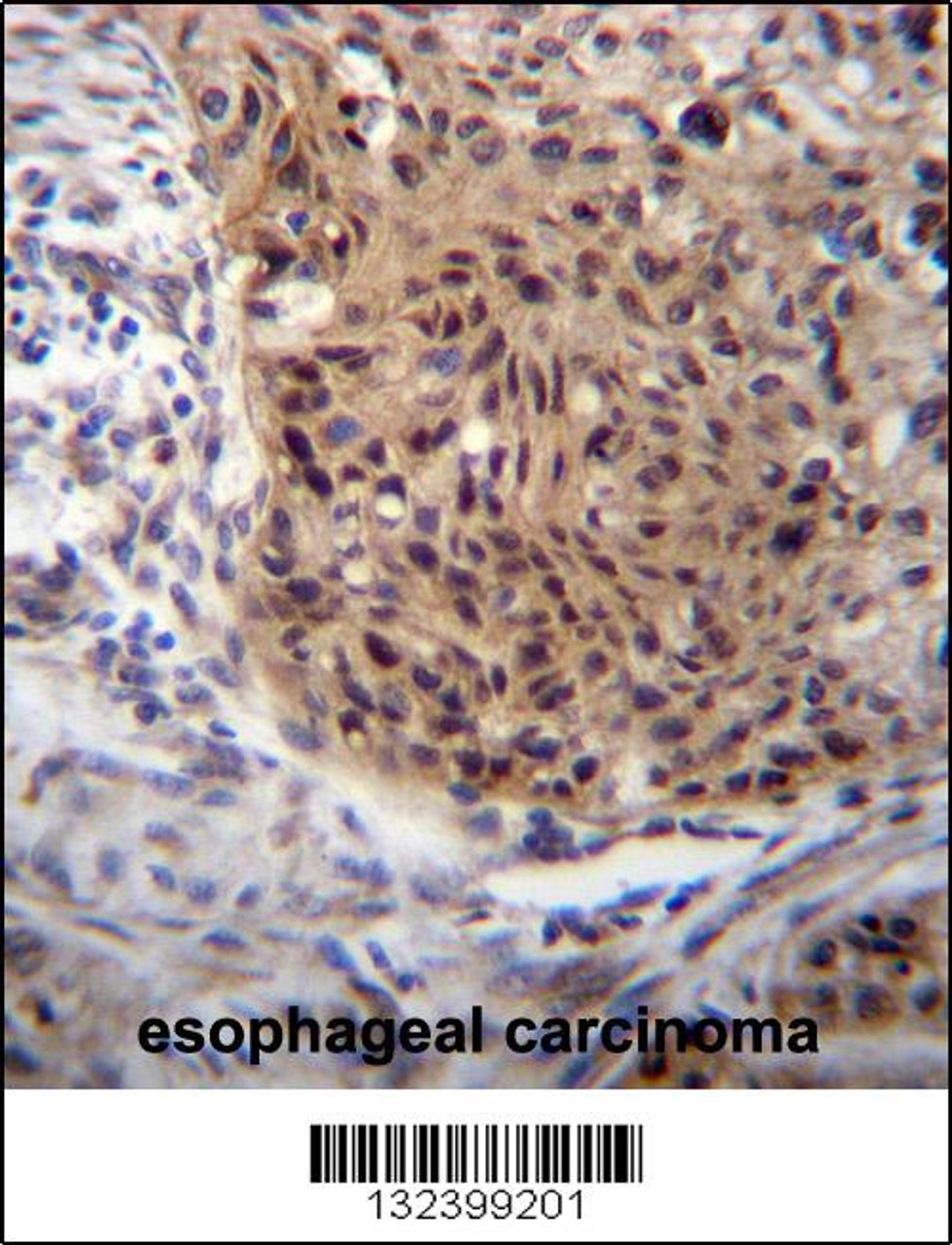 EXTL3 Antibody immunohistochemistry analysis in formalin fixed and paraffin embedded human esophageal carcinoma followed by peroxidase conjugation of the secondary antibody and DAB staining.