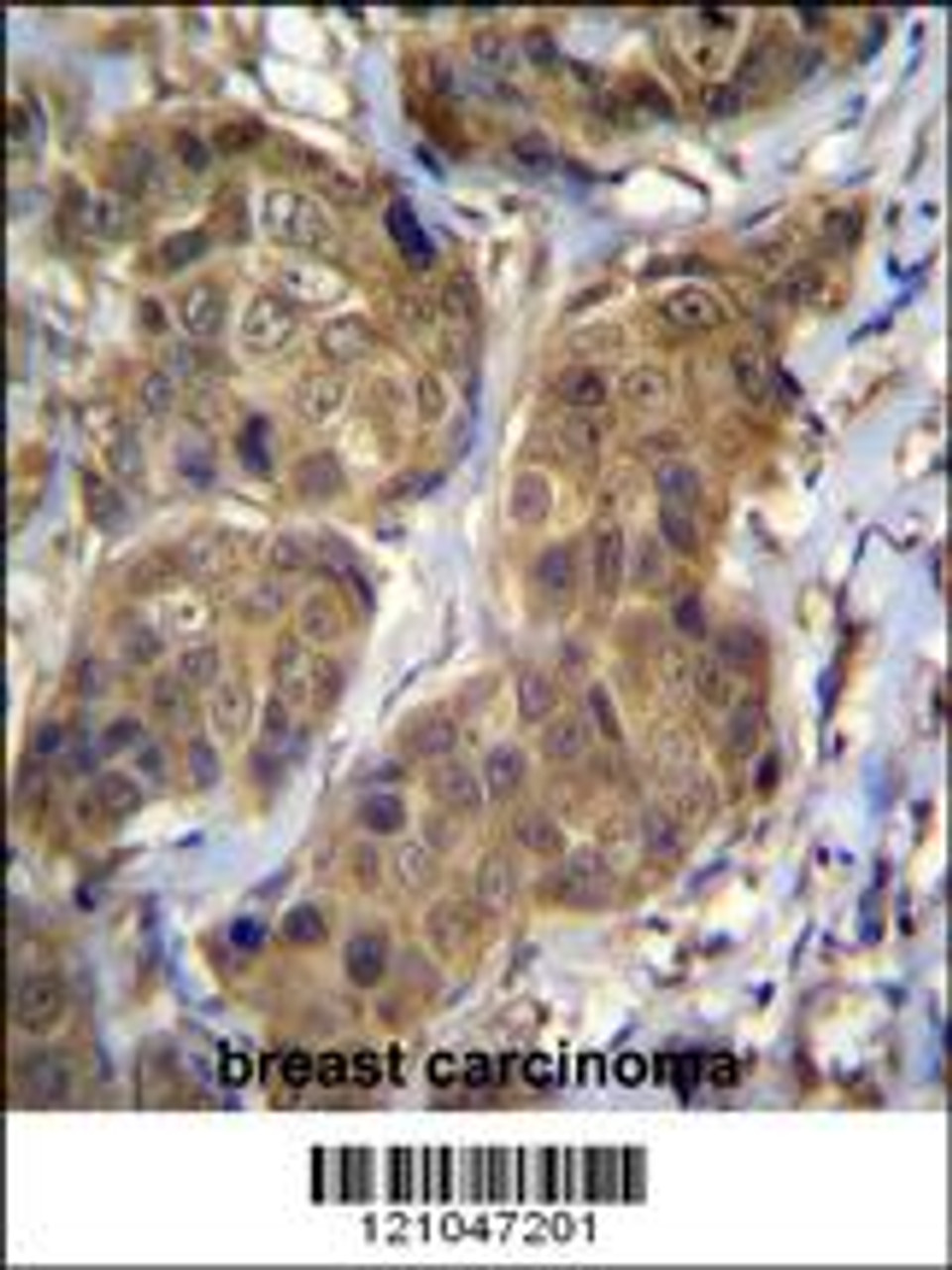 RNF11 Antibody immunohistochemistry analysis in formalin fixed and paraffin embedded human breast carcinoma followed by peroxidase conjugation of the secondary antibody and DAB staining.