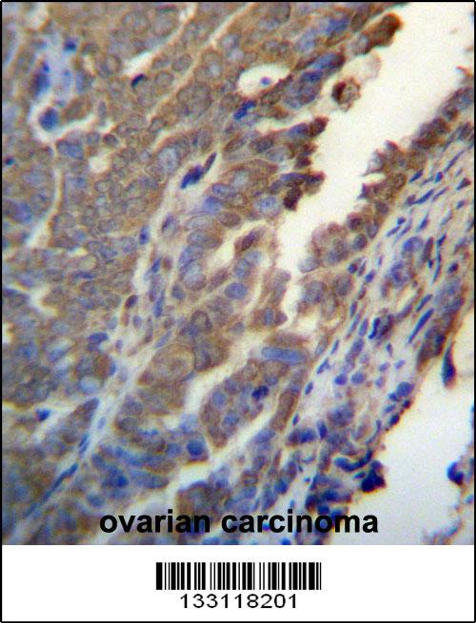 ASB4 Antibody immunohistochemistry analysis in formalin fixed and paraffin embedded human ovarian carcinoma followed by peroxidase conjugation of the secondary antibody and DAB staining.