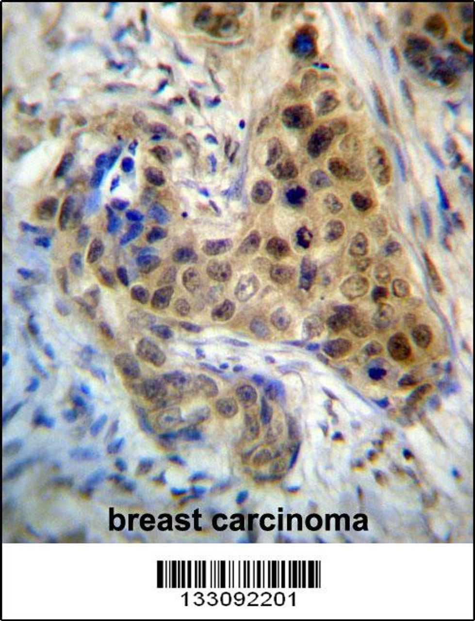 RPL3 Antibody immunohistochemistry analysis in formalin fixed and paraffin embedded human breast carcinoma followed by peroxidase conjugation of the secondary antibody and DAB staining.