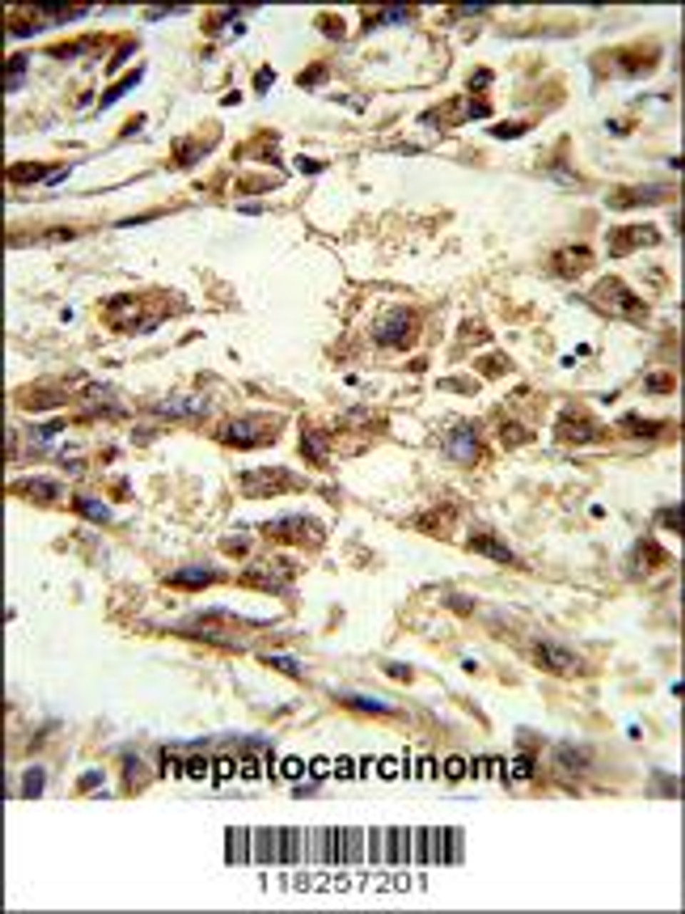 Formalin-fixed and paraffin-embedded human hepatocarcinoma reacted with AIFM2 Antibody, which was peroxidase-conjugated to the secondary antibody, followed by DAB staining.