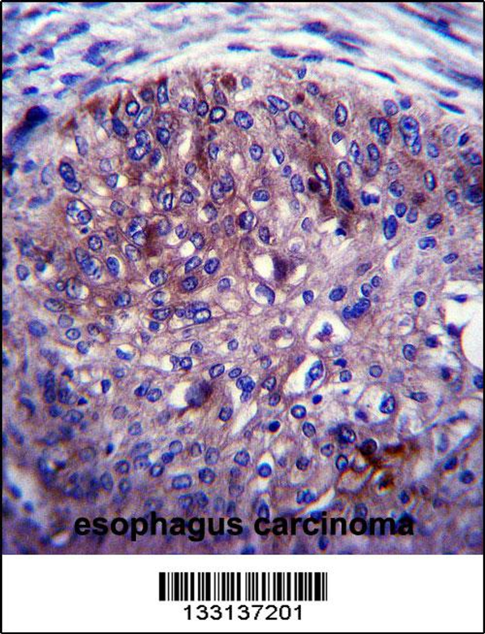 ADAL Antibody immunohistochemistry analysis in formalin fixed and paraffin embedded human esophagus carcinoma followed by peroxidase conjugation of the secondary antibody and DAB staining.