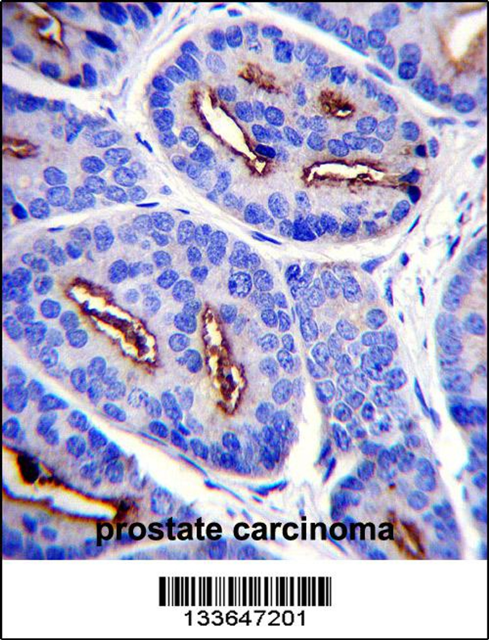 FOLH1 Antibody immunohistochemistry analysis in formalin fixed and paraffin embedded human prostate carcinoma followed by peroxidase conjugation of the secondary antibody and DAB staining.