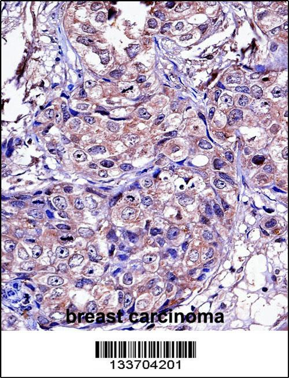MMP11 Antibody immunohistochemistry analysis in formalin fixed and paraffin embedded human breast carcinoma followed by peroxidase conjugation of the secondary antibody and DAB staining.