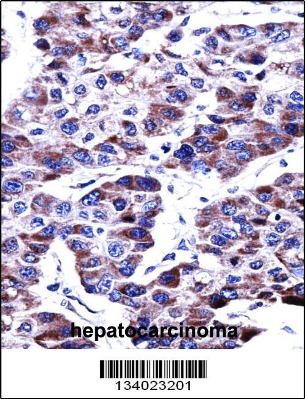 DUSP9 Antibody immunohistochemistry analysis in formalin fixed and paraffin embedded human hepatocarcinoma followed by peroxidase conjugation of the secondary antibody and DAB staining.