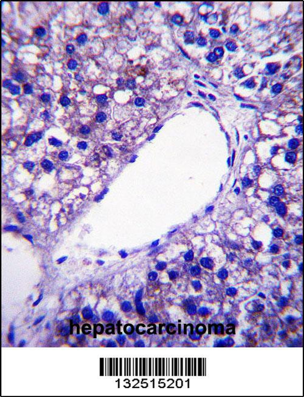 PNPLA4 Antibody immunohistochemistry analysis in formalin fixed and paraffin embedded human hepatocarcinoma followed by peroxidase conjugation of the secondary antibody and DAB staining.
