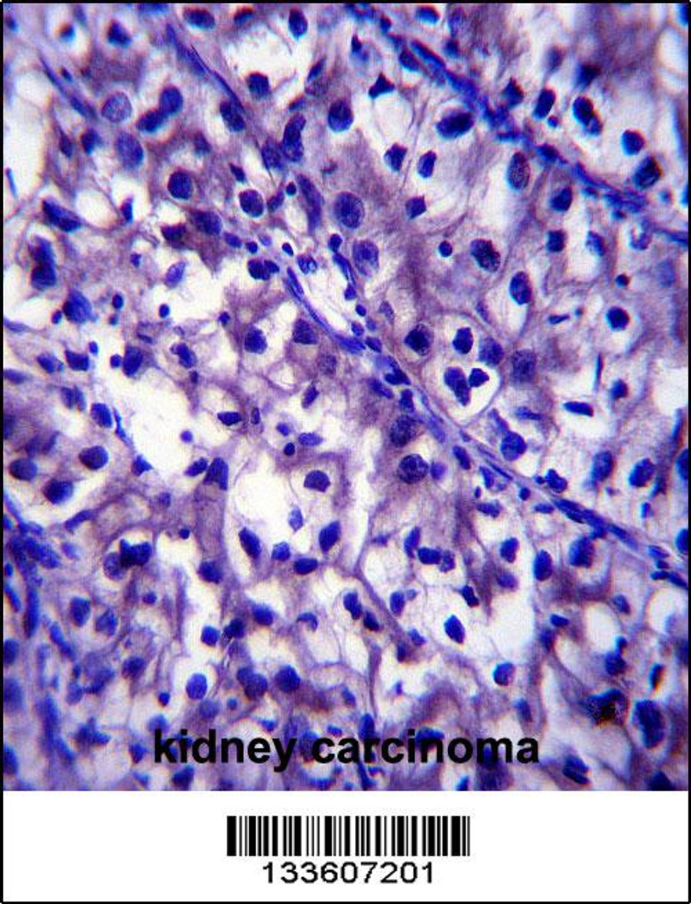 LAMB1 Antibody immunohistochemistry analysis in formalin fixed and paraffin embedded human kidney carcinoma followed by peroxidase conjugation of the secondary antibody and DAB staining.