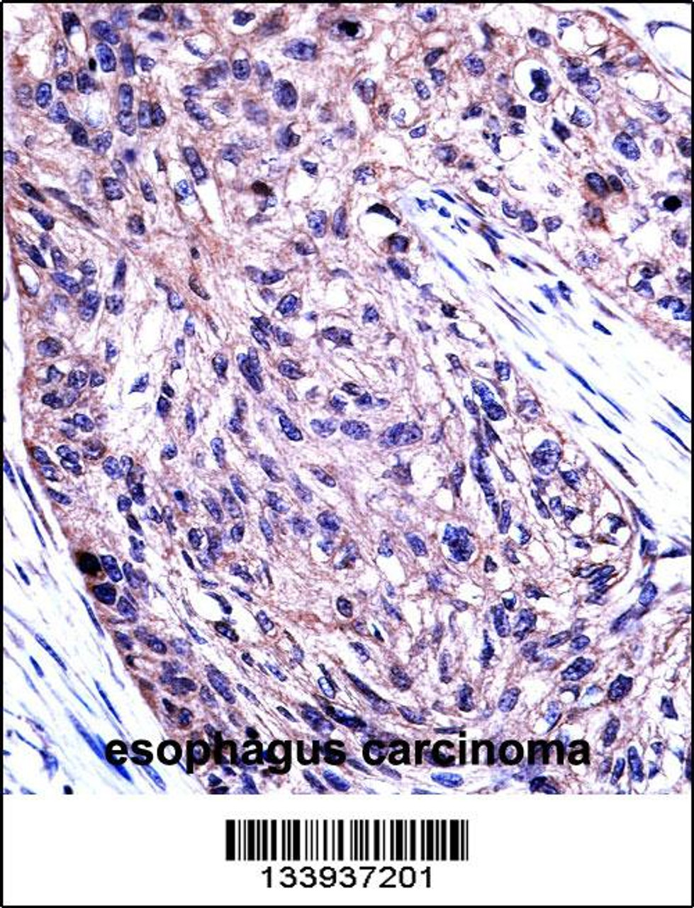 UBA7 Antibody immunohistochemistry analysis in formalin fixed and paraffin embedded human esophagus carcinoma followed by peroxidase conjugation of the secondary antibody and DAB staining.