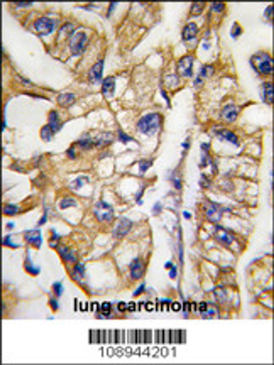 Formalin-fixed and paraffin-embedded human lung carcinoma tissue reacted with HDBP1 Antibody, which was peroxidase-conjugated to the secondary antibody, followed by DAB staining.