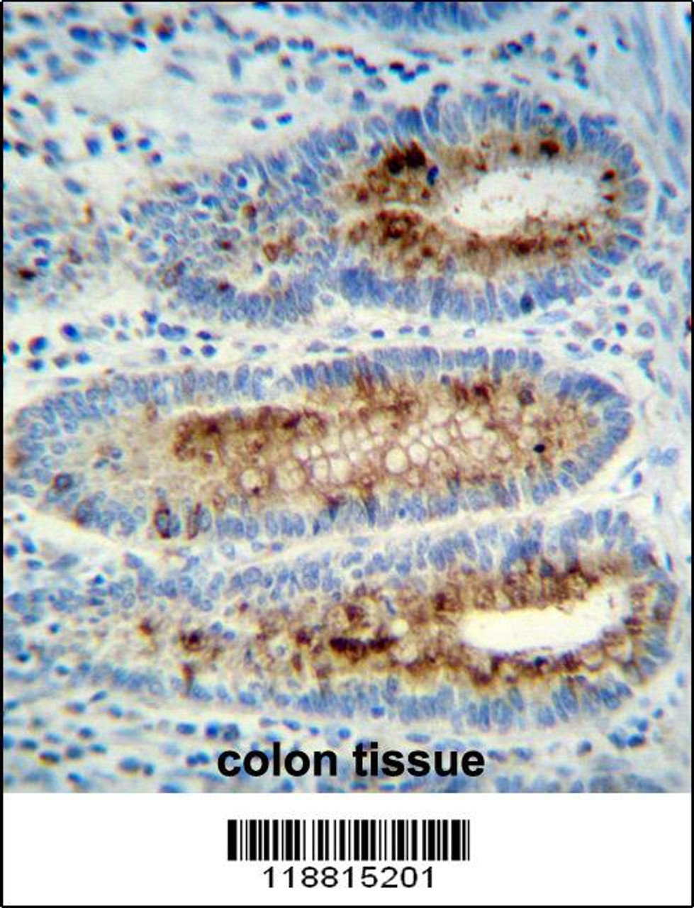 Myeloperoxidase Antibody immunohistochemistry analysis in formalin fixed and paraffin embedded human colon tissue followed by peroxidase conjugation of the secondary antibody and DAB staining.This data demonstrates the use of Myeloperoxidase Antibody for immunohistochemistry.