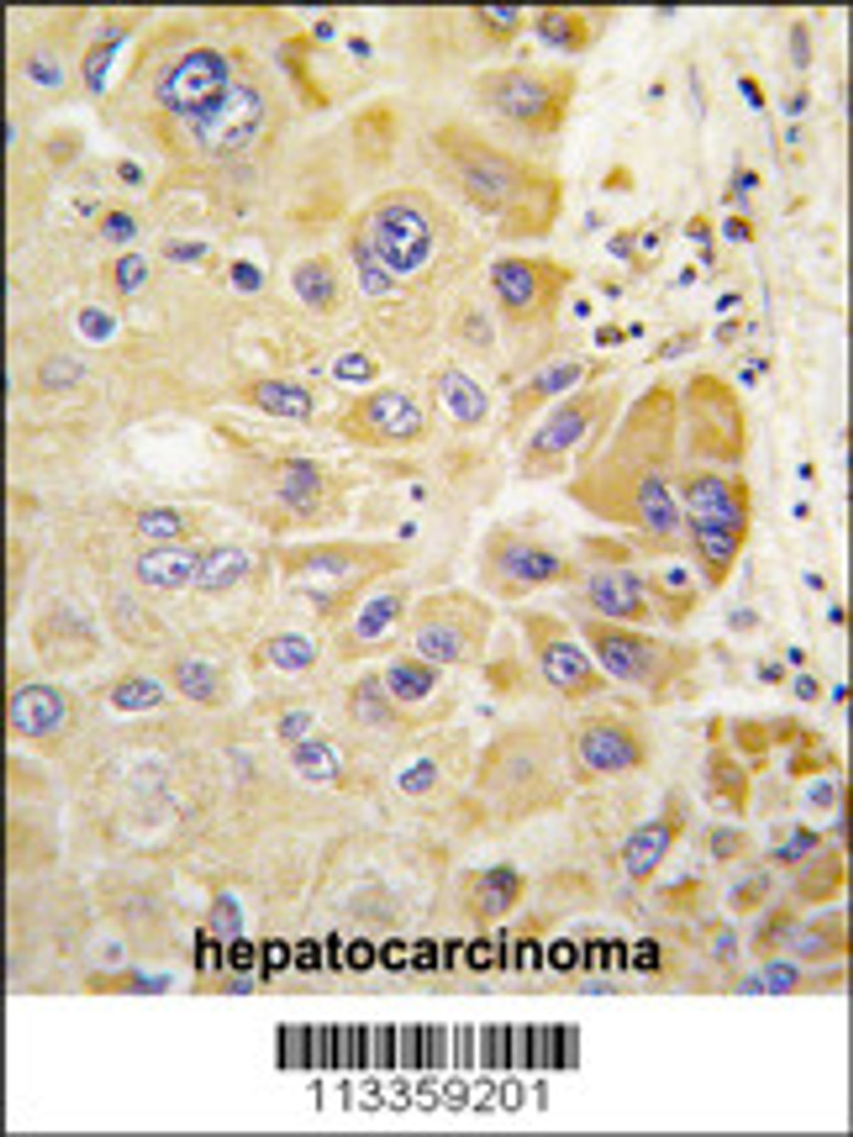 Formalin-fixed and paraffin-embedded human hepatocarcinoma tissue reacted with ALDH2 antibody, which was peroxidase-conjugated to the secondary antibody, followed by DAB staining.