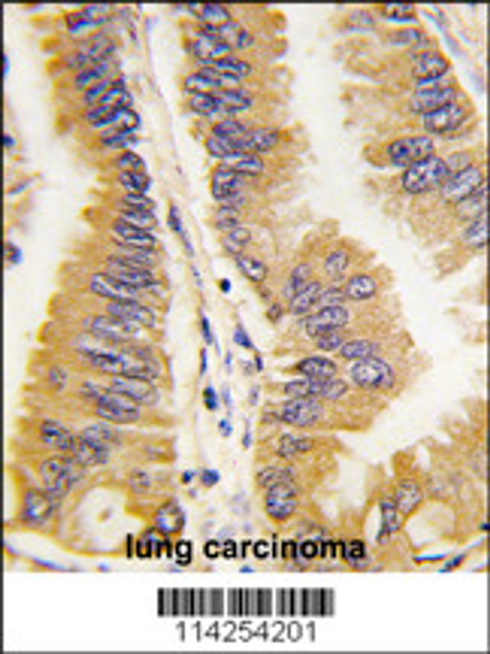 Formalin-fixed and paraffin-embedded human lung carcinoma tissue reacted with FRAT1 antibody, which was peroxidase-conjugated to the secondary antibody, followed by DAB staining.