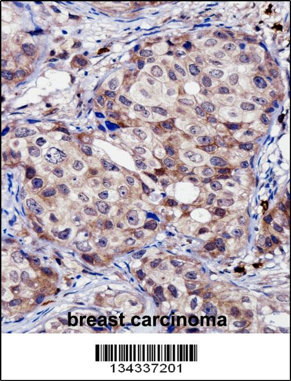 RNF144A Antibody immunohistochemistry analysis in formalin fixed and paraffin embedded human breast carcinoma followed by peroxidase conjugation of the secondary antibody and DAB staining.