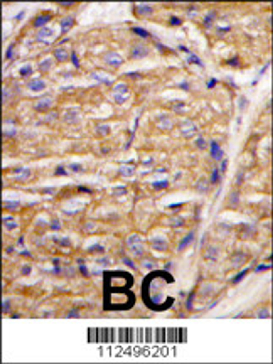 Formalin-fixed and paraffin-embedded human breast carcinoma tissue reacted with MIPEP antibody, which was peroxidase-conjugated to the secondary antibody, followed by DAB staining.