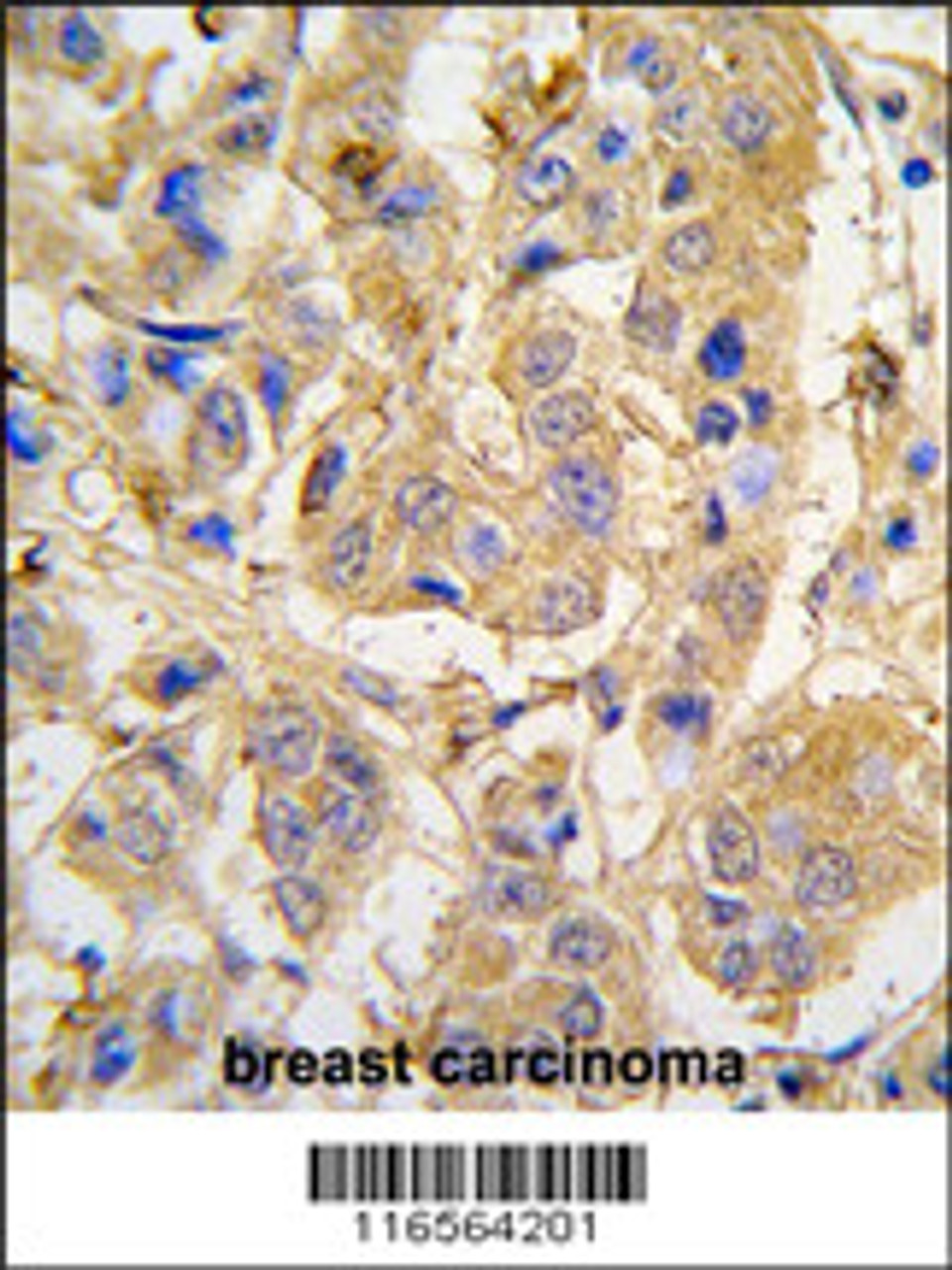 Formalin-fixed and paraffin-embedded human breast carcinoma tissue reacted with MIPEP antibody, which was peroxidase-conjugated to the secondary antibody, followed by DAB staining.