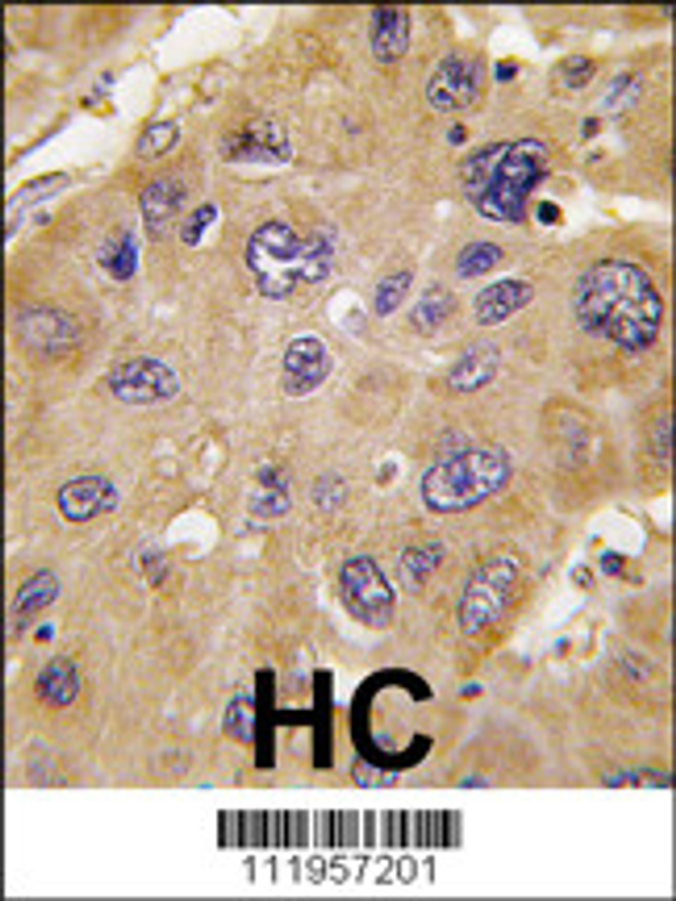Formalin-fixed and paraffin-embedded human hepatocarcinoma tissue reacted with *ALDH6A1 antibody, which was peroxidase-conjugated to the secondary antibody, followed by DAB staining.