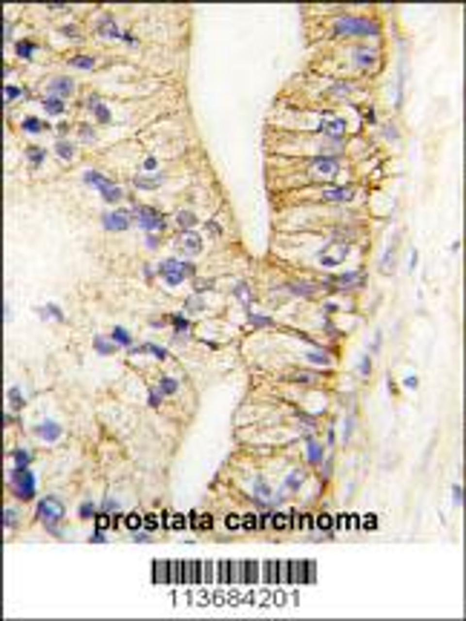 Formalin-fixed and paraffin-embedded human prostata carcinoma tissue reacted with CDH7 antibody, which was peroxidase-conjugated to the secondary antibody, followed by DAB staining.