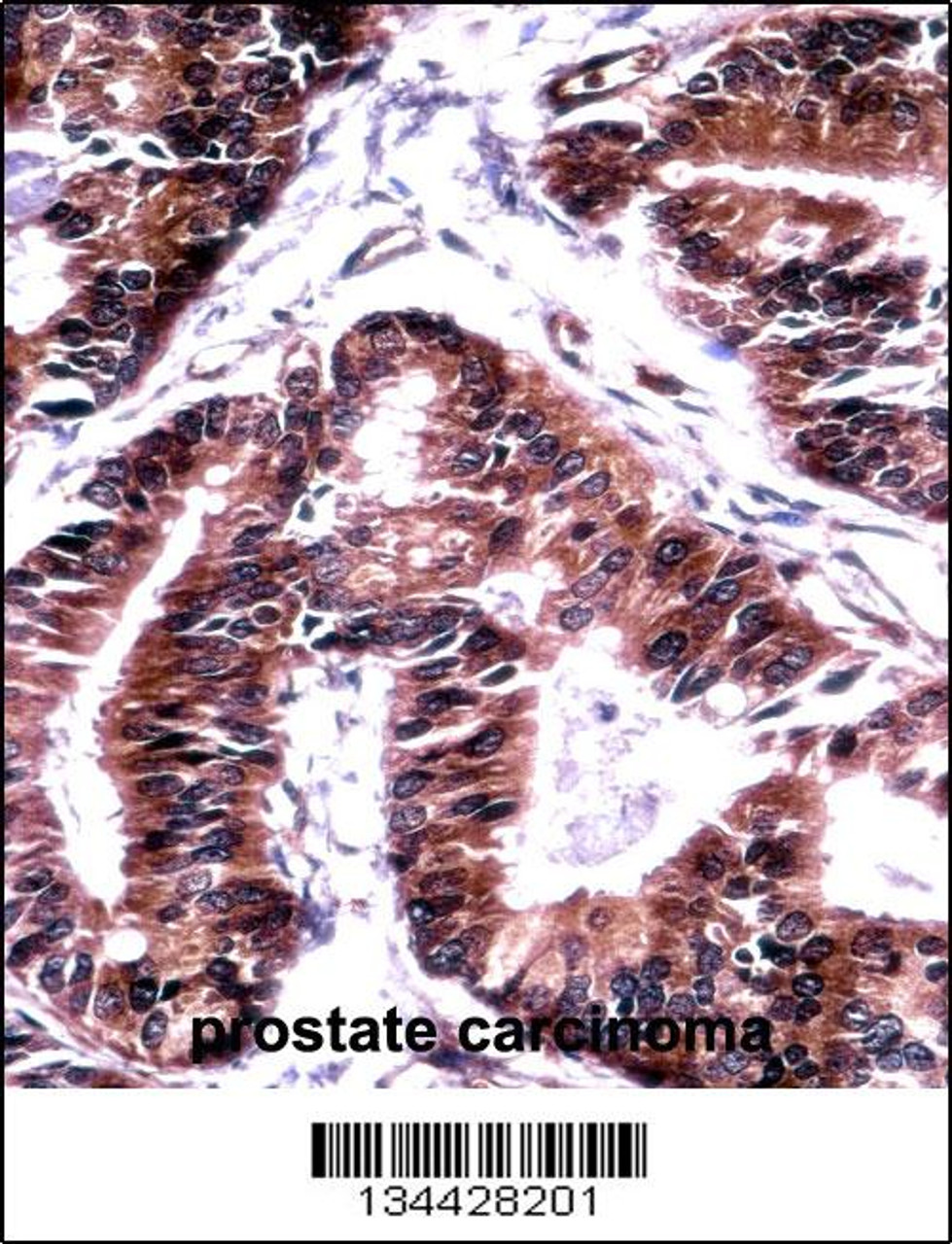 TCEB1 Antibody immunohistochemistry analysis in formalin fixed and paraffin embedded human prostate carcinoma followed by peroxidase conjugation of the secondary antibody and DAB staining.